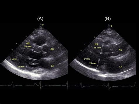 lv parasternal long axis systole|Left Ventricular Function .